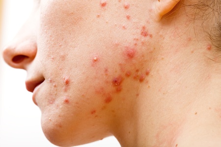 nutrition for acne