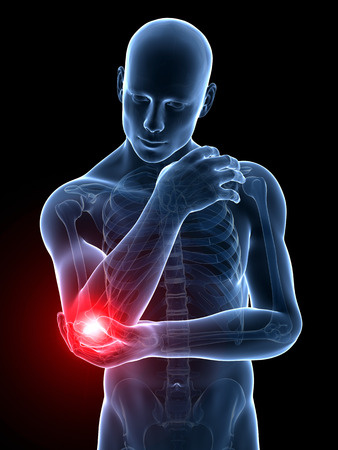 tennis elbow